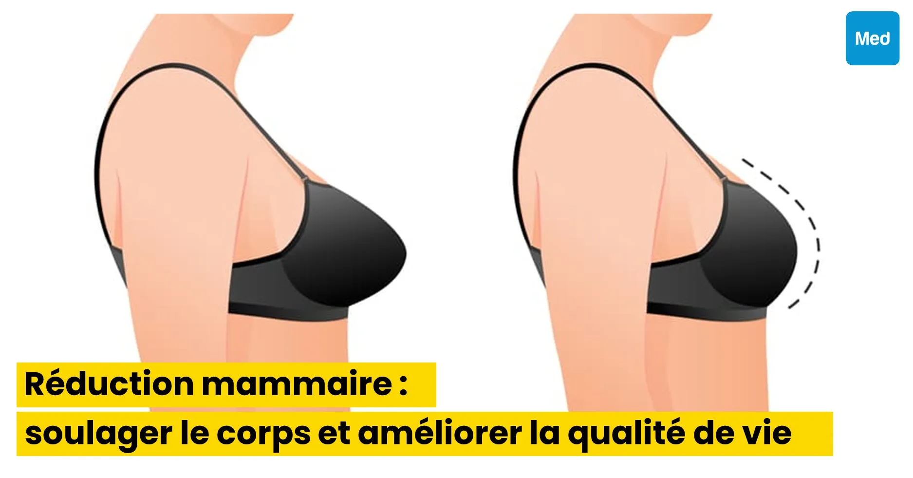 Réduction mammaire : soulager le corps et améliorer la qualité de vie